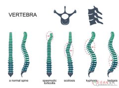 22岁脊柱侧弯能矫正吗？科学方案帮你控进展稳脊柱