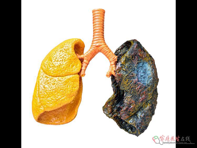 别混淆！痰湿和咳嗽咳痰不是一回事