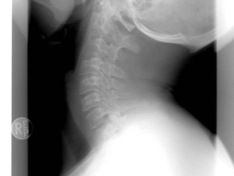 颈椎转着响还突出？可能是关节紊乱在预警