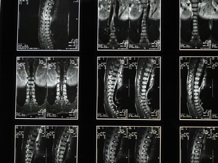 中医辅助调理脊髓炎：3个核心方法提升恢复效果