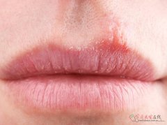 易上火总口腔溃疡？3招科学调理不反复