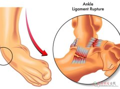 脚踝肿痛别忽视！4个病因及科学应对法
