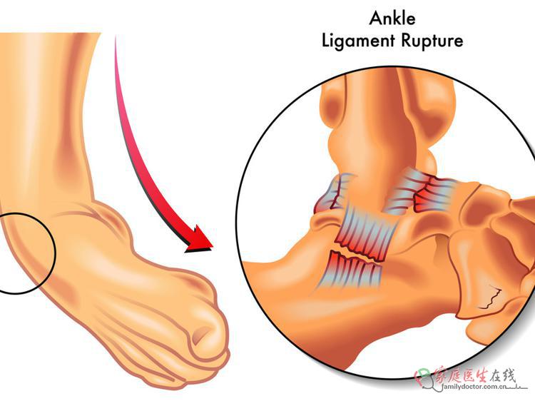 脚踝肿痛别忽视!4个病因及科学应对法 脚踝肿痛别忽视!4个病因及科学应对法