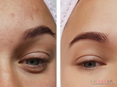 职业性痤疮别乱治！中医辨证4型用药指南