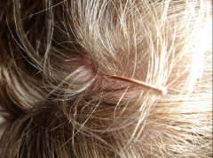 百会穴缓解健忘：原理、方法与避坑指南