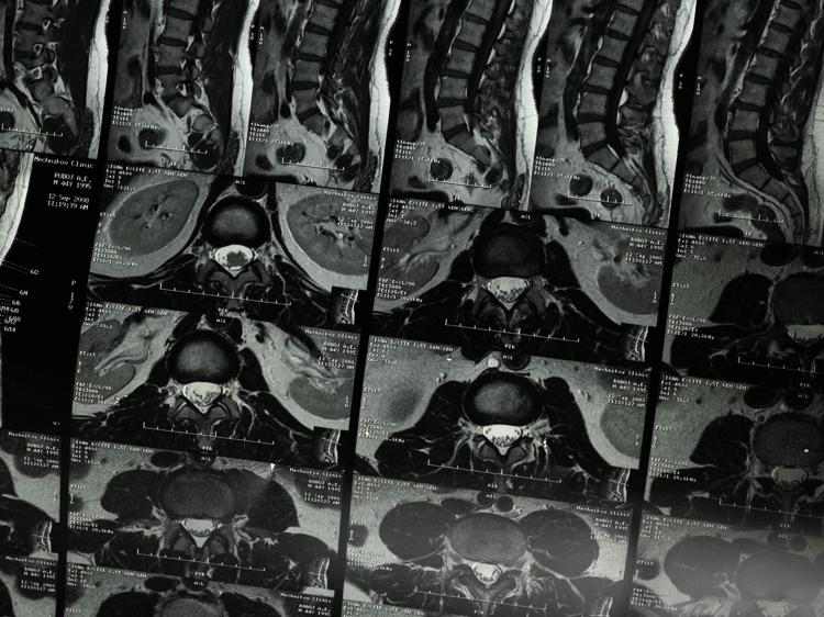 骨质增生致左腿发麻？关键看腰椎神经是否受压