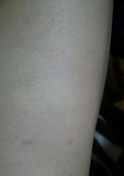 为什么狗狗要咬自己的腿？（探究狗狗咬腿行为的原因和解决方法）