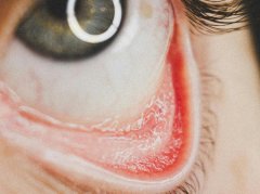 红眼病发作？5个穴位可辅助缓解眼部不适