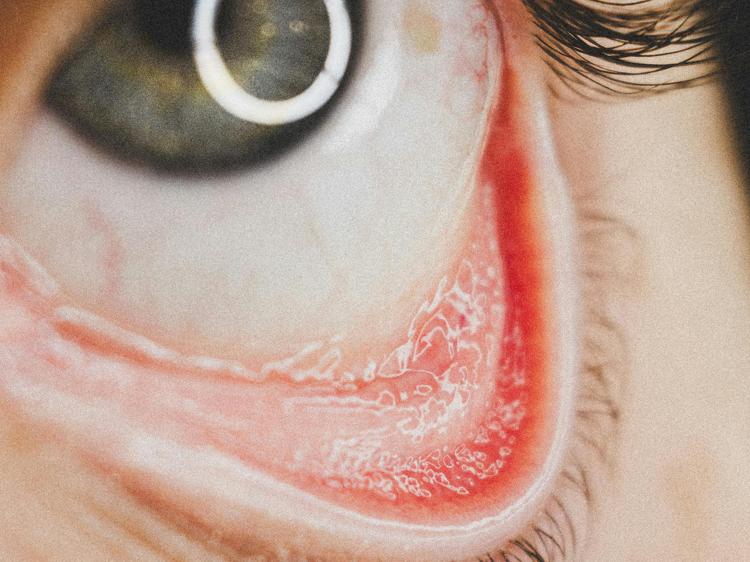 红眼病发作？5个穴位可辅助缓解眼部不适