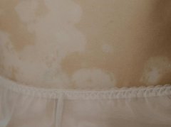 中医如何调理色素脱失？3大方法+避坑指南