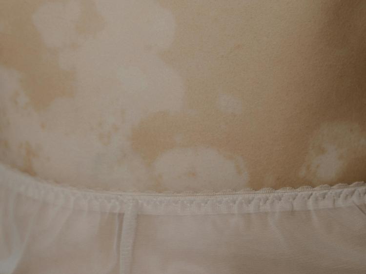 中医如何调理色素脱失？3大方法+避坑指南