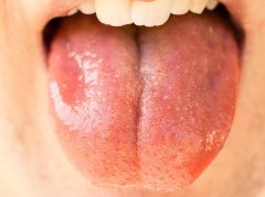 舌后部舌苔厚白？3步分清正常异常+科学应对指南