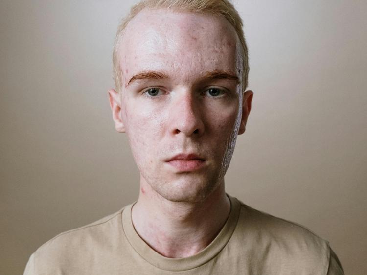 手指甲空洞不疼不痒?可能是扁平苔藓在搞鬼 手指甲空洞不疼不痒?可能是扁平苔藓在搞鬼