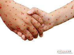 带状疱疹后神经痛：药物+针灸+生活调理，科学缓解疼痛