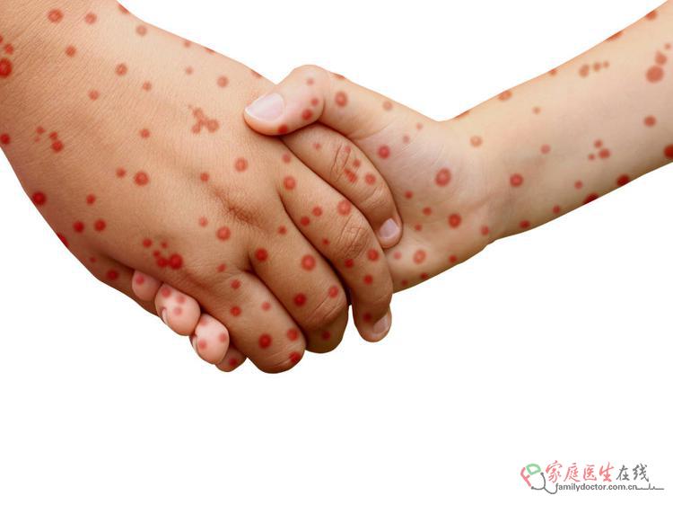 带状疱疹后神经痛：药物+针灸+生活调理，科学缓解疼痛