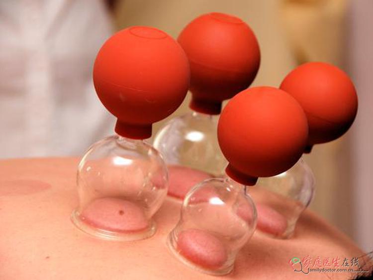 拔罐减肥对肥胖症患者的作用及科学安全指南