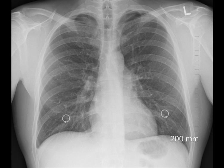 早起喉咙有痰?分清痰湿与西医病因,科学应对不踩坑 早起喉咙有痰?分清痰湿与西医病因,科学应对不踩坑
