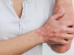 白疕（银屑病）中医证型解析：科学应对少走弯路