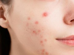 头脸油腻总反复？4步科学方案帮你清爽