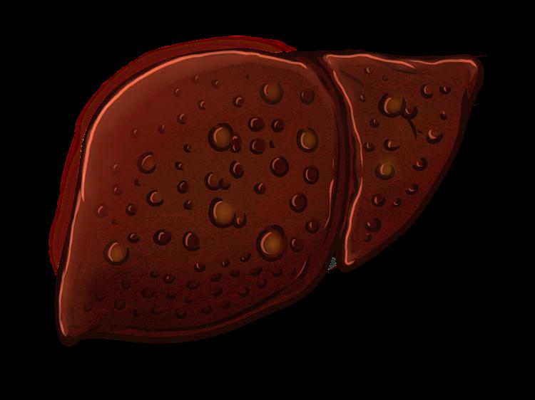 肝胆湿热型口臭调理:从根源到方法,科学改善不踩坑 肝胆湿热型口臭调理:从根源到方法,科学改善不踩坑